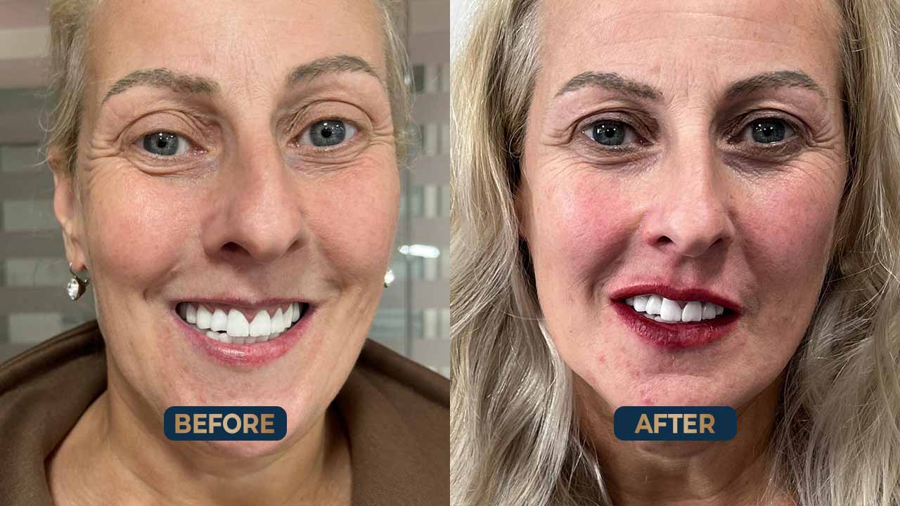 Lip Blush treatment Before & After