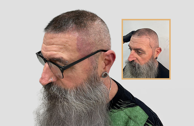 scalp micropigmentation