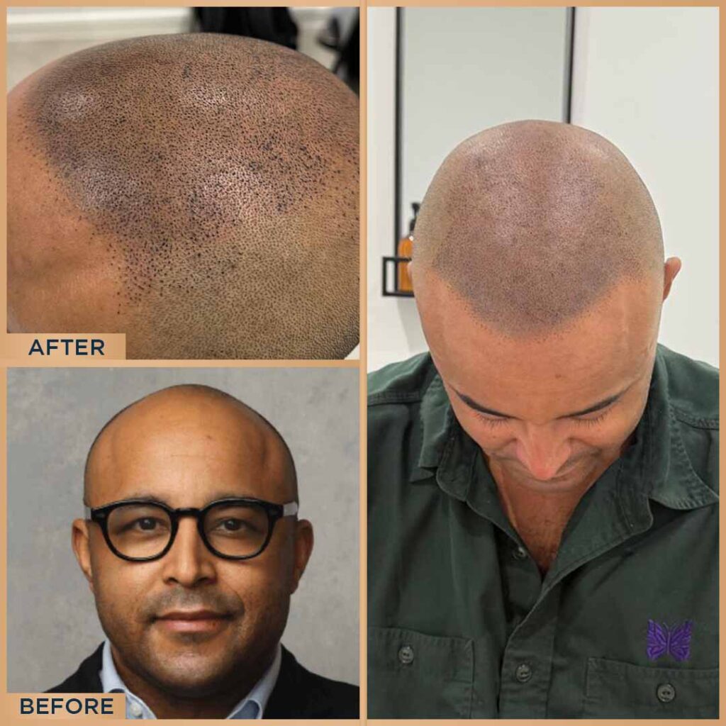 Scalp Micropigmentation