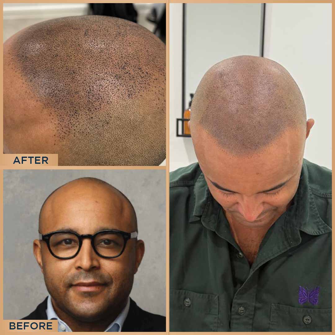 Scalp Micropigmentation