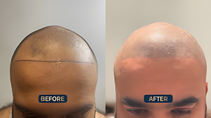Cost of Scalp Micropigmentation in London