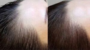 Hairline Microblading London – Pros, Cons & Alternatives