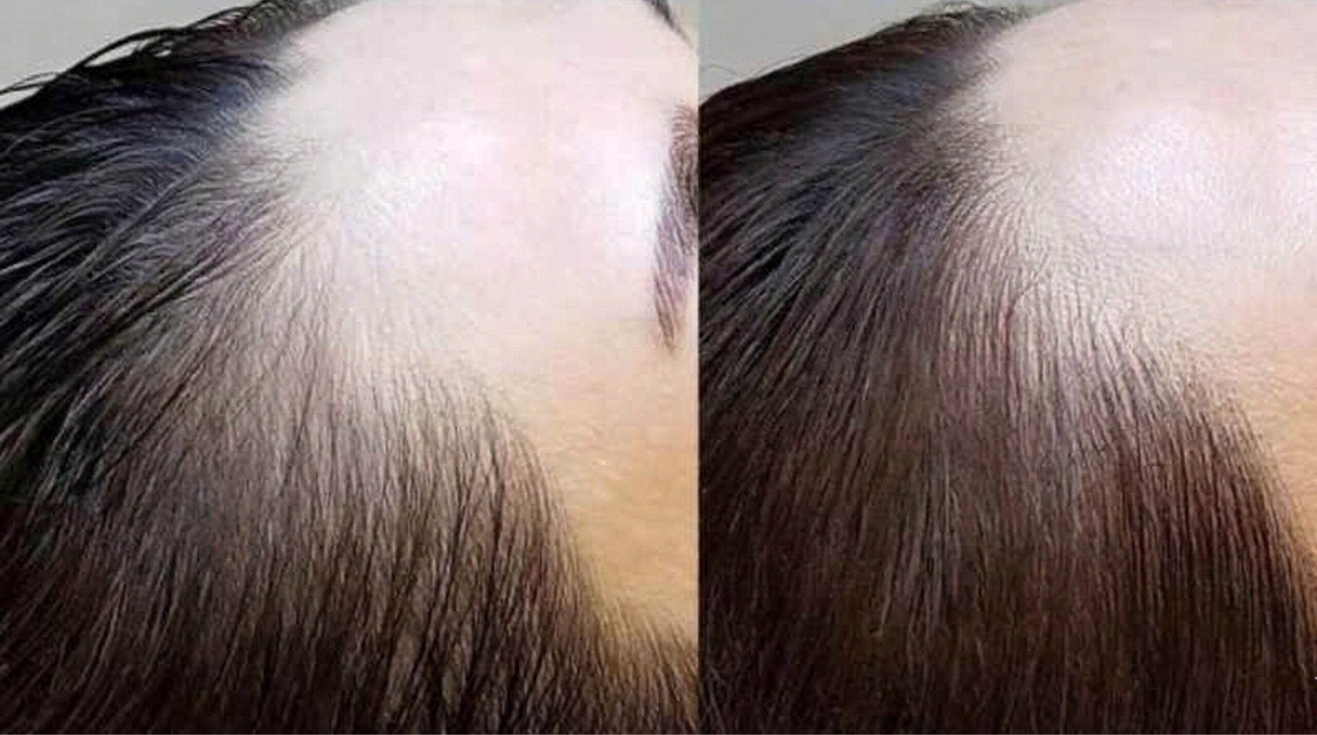 Hairline Microblading London – Pros, Cons & Alternatives