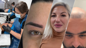 Scalp Micropigmentation in London – Complete Guide